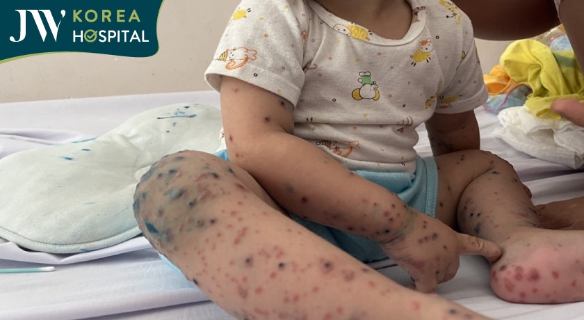 Bệnh tay chân miệng ở trẻ