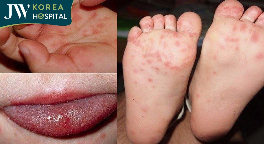 Bệnh tay chân miệng