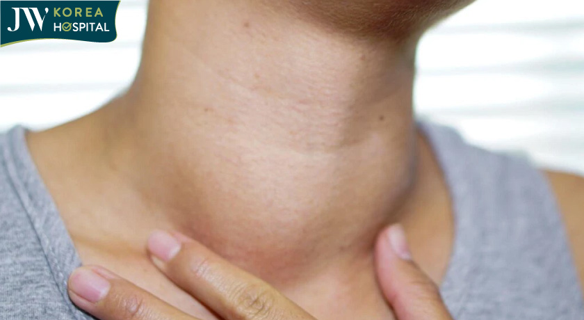 Dấu hiệu nhận biết bệnh bướu cổ