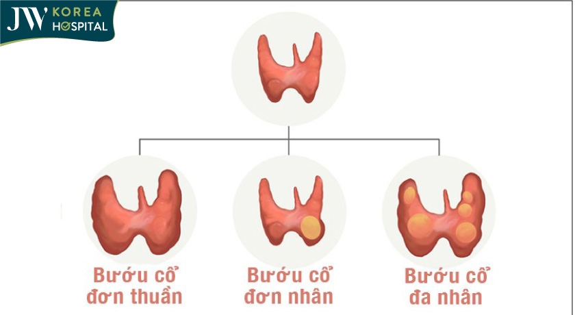 Kích thước của các loại bướu cổ