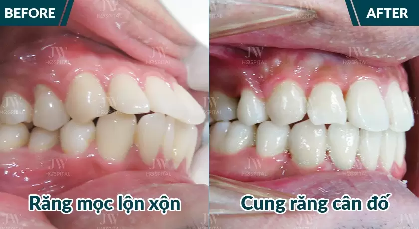 Chỉnh nha - khớp cắn đưa vào vị trí chuẩn 