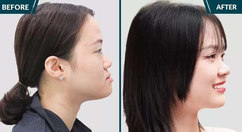 Cô gái xinh đẹp hơn sau khi niềng răng