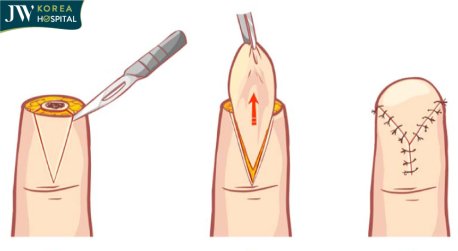 phương pháp chuyện vạc da