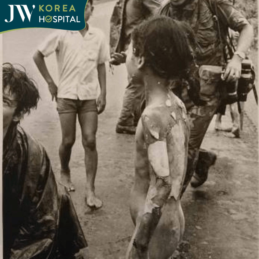 Cô gái Napalm bị bỏng toàn thân