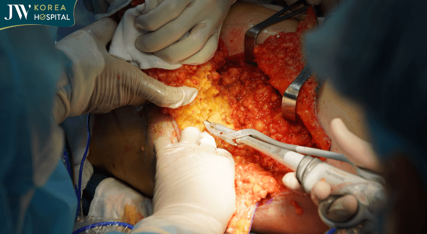 Công nghệ dao mổ siêu âm Harmonic tại JW