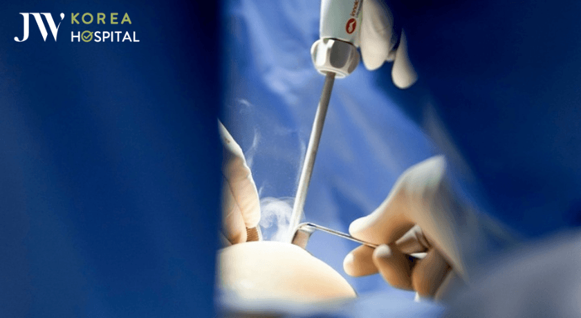 Ứng dụng dao mổ siêu âm Harmonic trong Nâng ngực