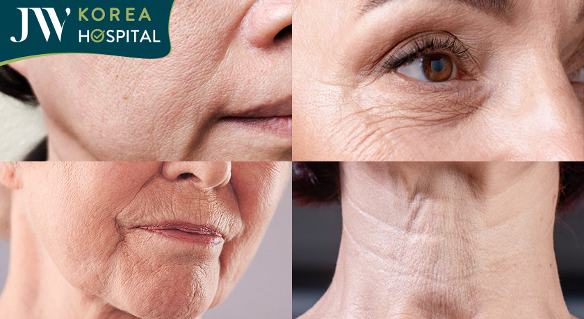 Đối tượng phù hợp nâng cơ, xóa nhăn RF