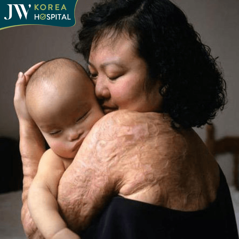 Em bé Napalm mang trên mình vết sẹo hậu quả chiến tranh để lại