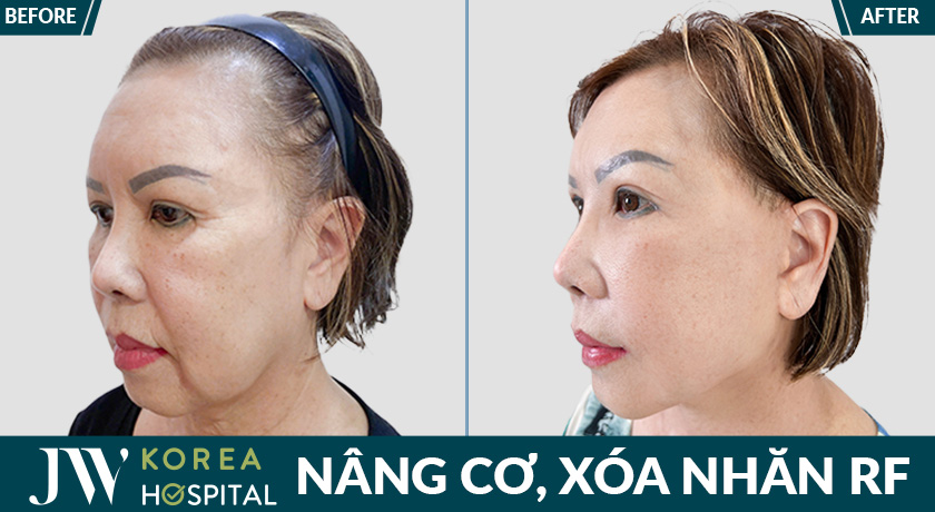 khách hàng sau khi thực hiện nâng cơ xóa nhăn RF tại Bệnh viện JW