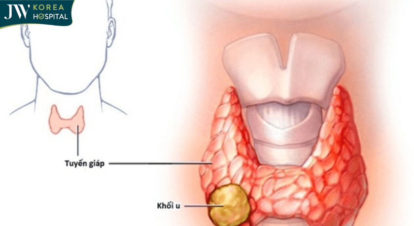 khối U bướu cổ