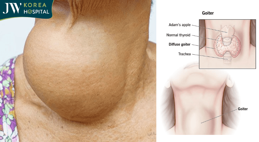 khối U phình to ở cổ