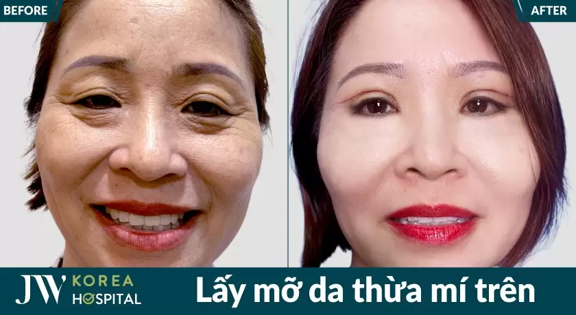 lay mo da thua mi tren 458x251