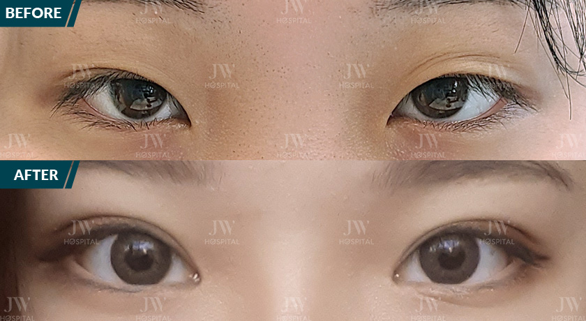 cận cảnh trước và sau cắt mí tại Bệnh viện JW