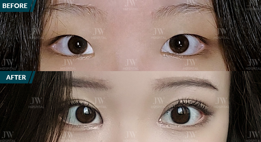 cận cảnh trước và sau cắt mí tại Bệnh viện JW