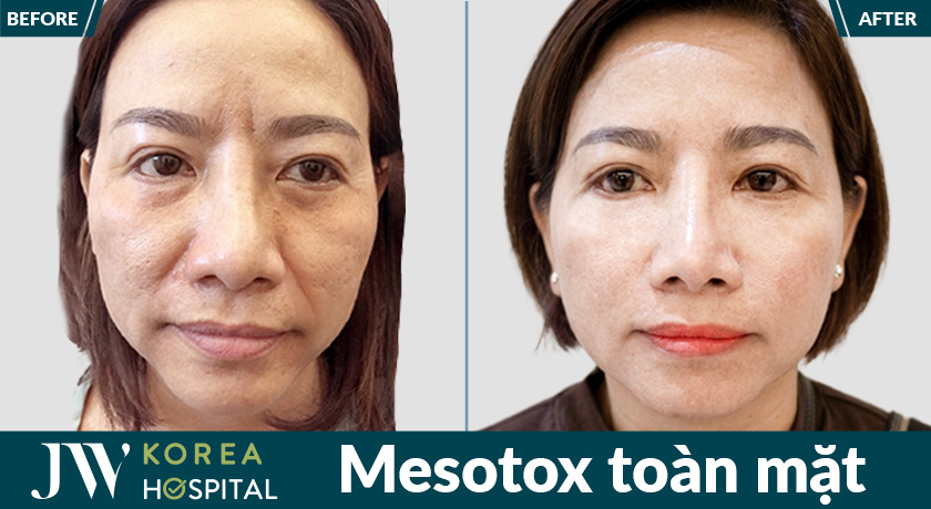 Mesotox toàn mặt