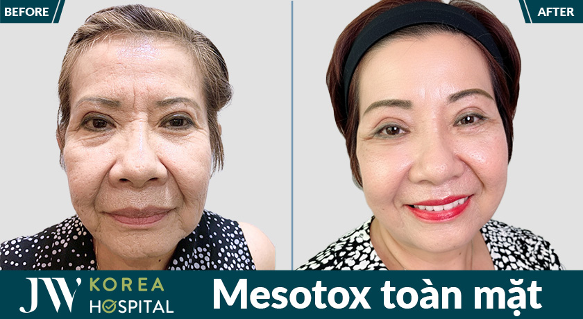 Mesotox toàn mặt