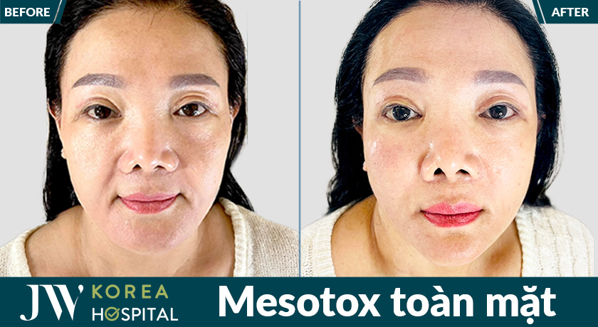Mesotox toàn mặt