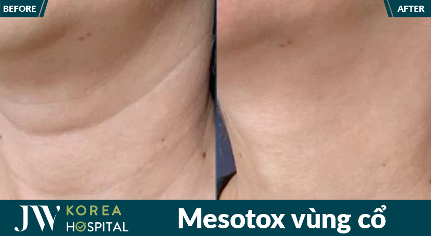 Mesotox vùng cổ