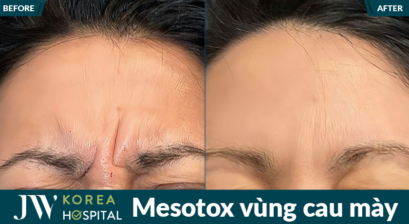 Mesotox vùng cau mày