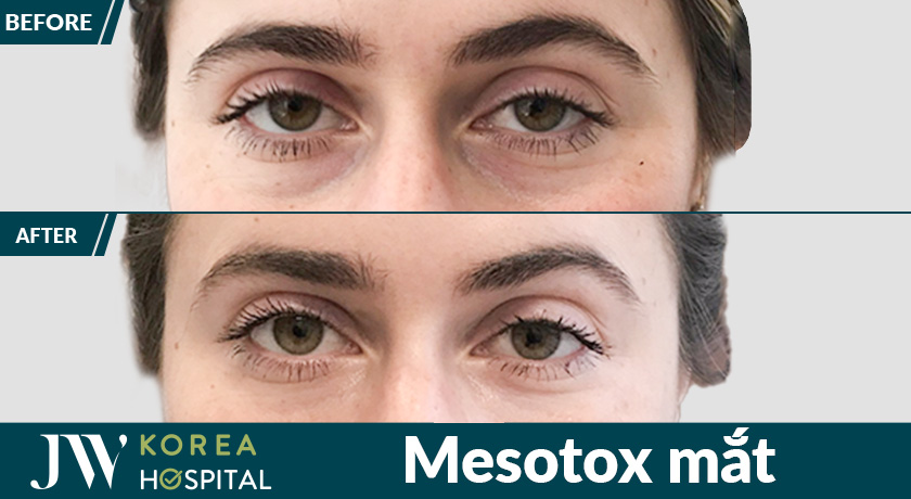 Mesotox vùng mắt, trẻ hóa mắt