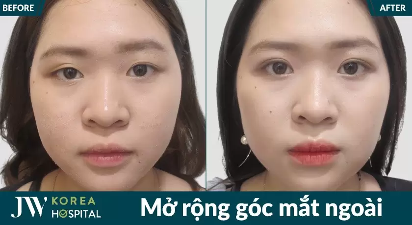 Sở hữu đôi mắt to tròn sau phẫu thuật mắt tại bệnh viện jw hàn quốc