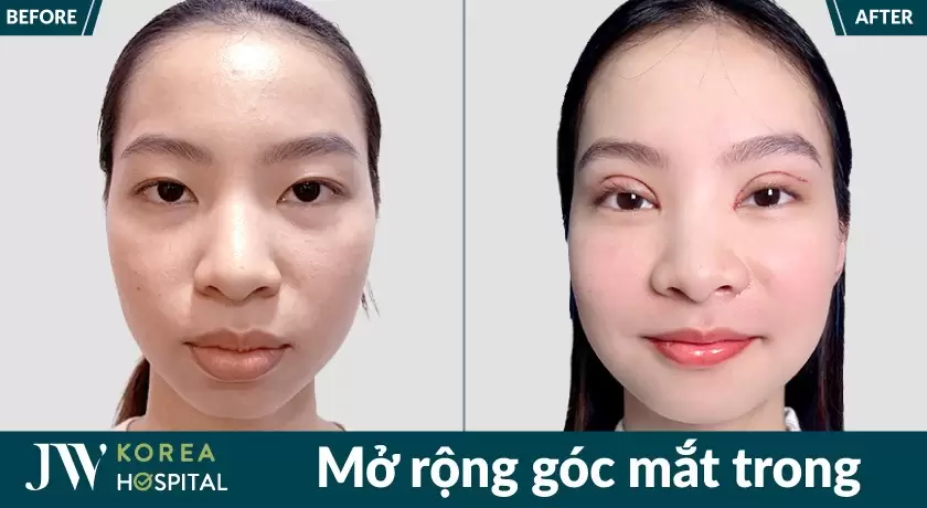 Cô gái sở hữu đôi mắt cuốn hút sau phẫu thuật tại bệnh viện jw hàn quốc