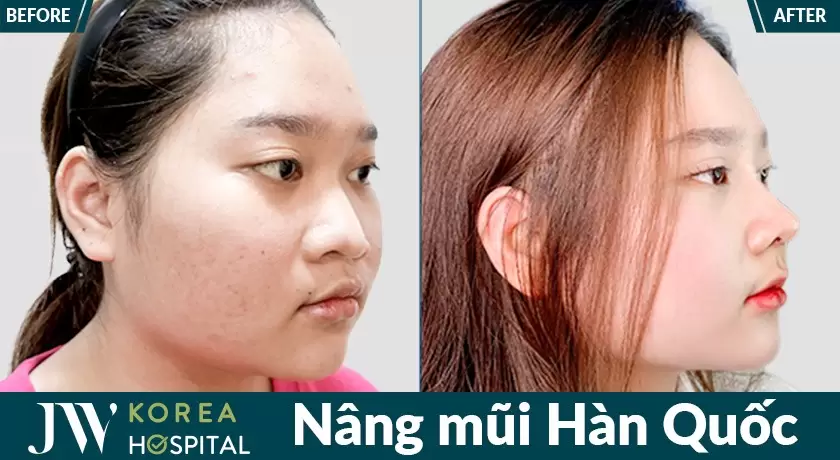 nâng mũi chuẩn Hàn Quốc tại Bệnh viện JW