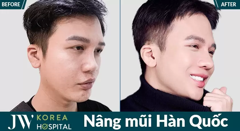 Nâng mũi nam tại Bệnh viện JW Hàn Quốc