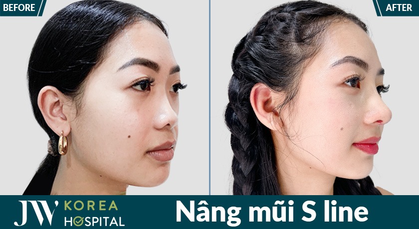 Đẹp như Hot Girl sau khi nâng mũi Sline