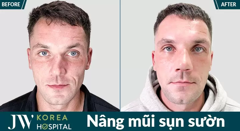 Khách nước ngoài chỉnh sửa mũi hỏng tại Bệnh viện JW Hàn Quốc