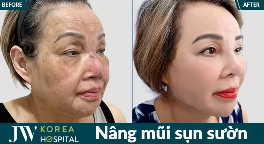 Chỉnh sửa mũi biến chứng an toàn tại Bệnh viện JW Hàn Quốc