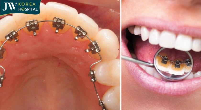 Niềng răng mắc cài mặt trong