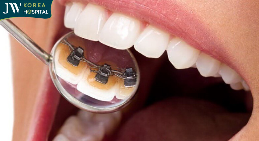 Niềng răng thẩm mỹ - gắn mắc cài mặt trong