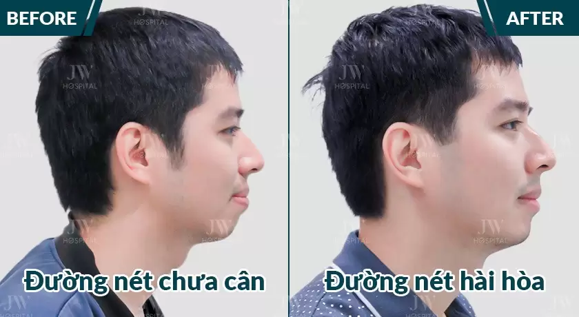 Thanh niên niềng răng tại Bệnh viện JW Hàn Quốc 