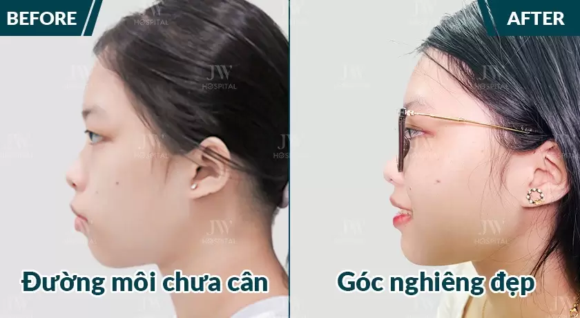 Niềng răng trẻ em an toàn tại Bệnh viện JW Hàn Quốc