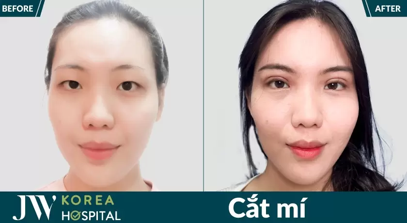 Thẩm mỹ cắt mí an toàn tại Bệnh viện JW Hàn Quốc