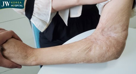 sẹo bỏng co rút da