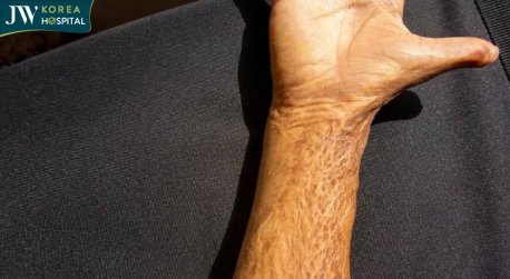 sẹo bỏng co rút da