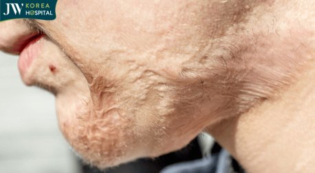 sẹo bỏng co rút da