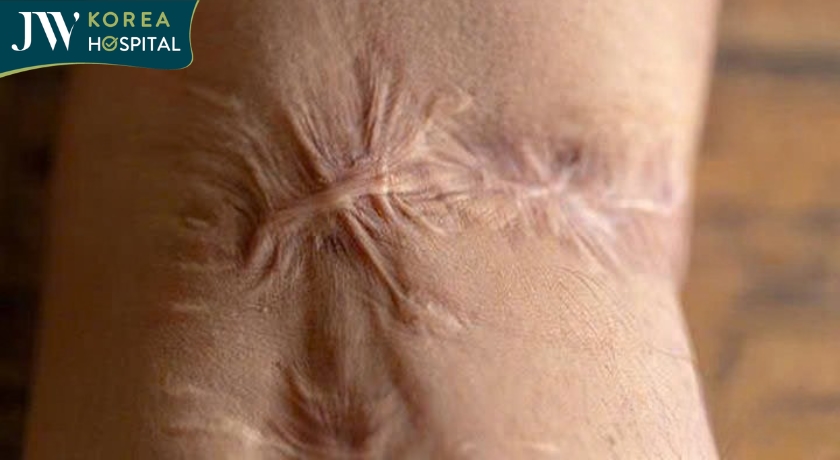 Sẹo do bom đạn chiến tranh để lại 