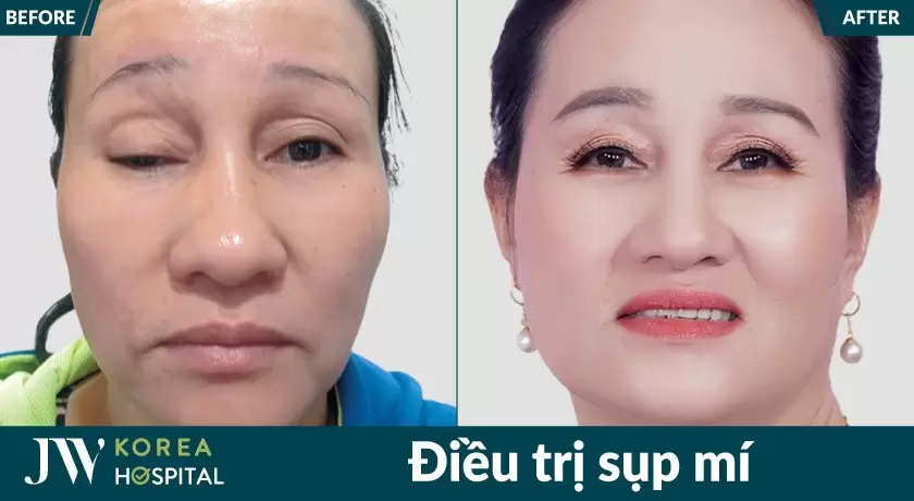 Quý cô lấy lại vẻ rạng rỡ sau phẫu thuật sụp mi mắt