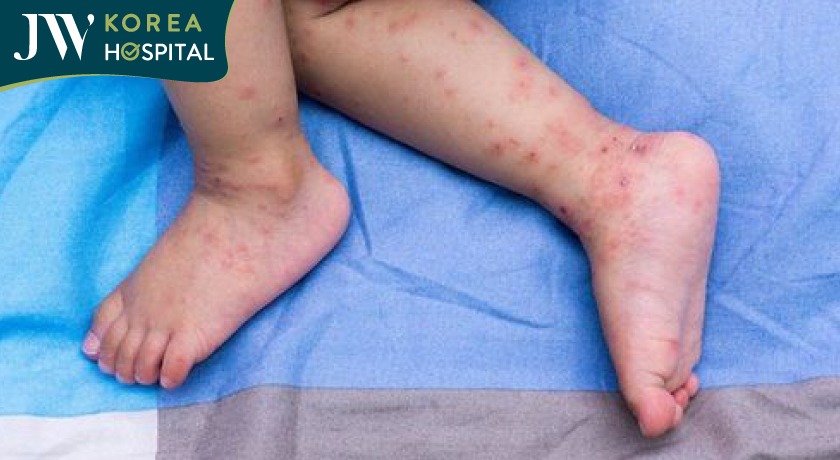 bệnh tay chân miệng