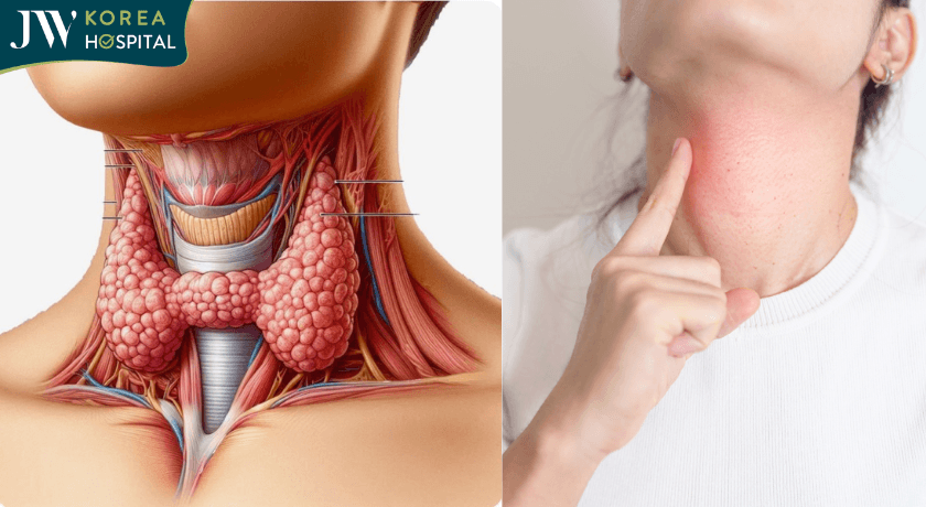 tình trạng bướu cổ hiện nay