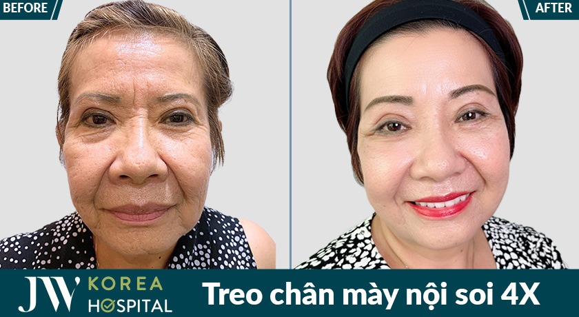 Quý bà trẻ ra hơn 20 tuổi nhờ cải thiện lão hóa tại Bệnh viện JW