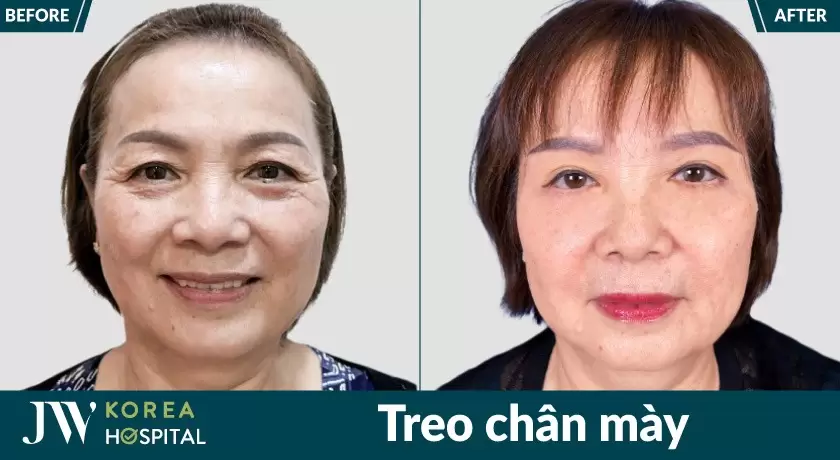 Quý bà trẻ hơn 10 tuổi sau khi nâng chân mày
