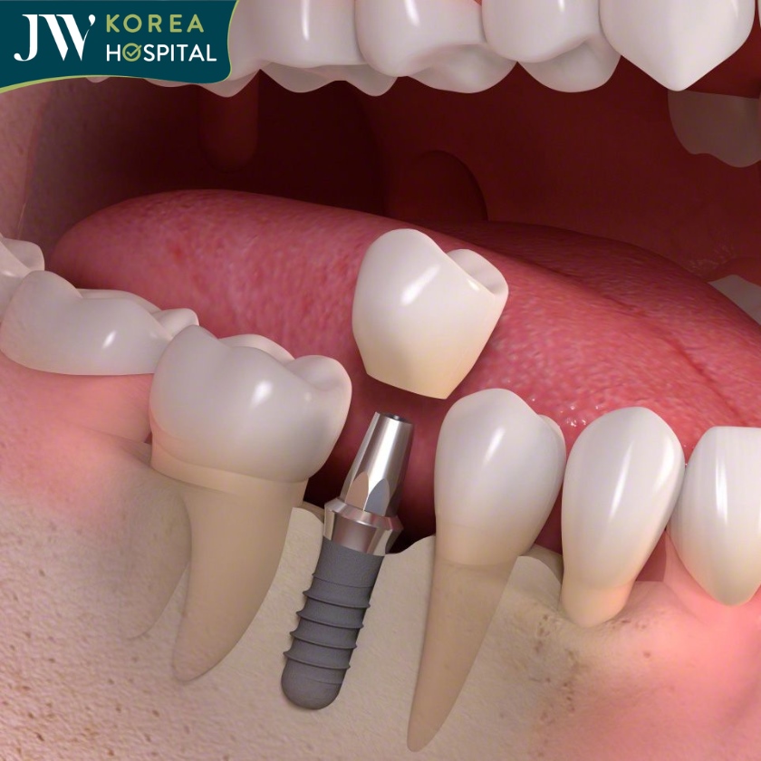 Implant giúp ngăn ngừa tình trạng tiêu xương hàm hiệu quả