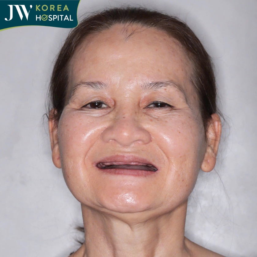 U50 - U80 mất răng lâu năm nên trồng răng Implant ăn ngon ngủ khỏe