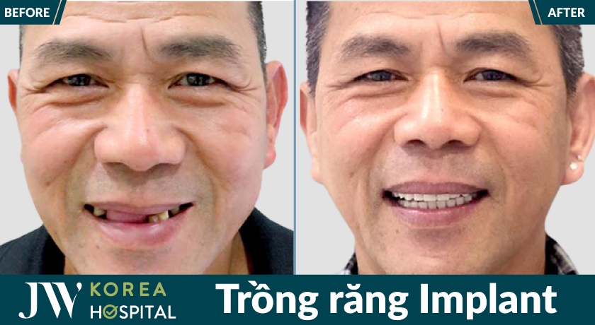 U50 - U80 mất răng lâu năm vẫn ăn ngon ngủ khỏe với trồng răng Implant tại JW