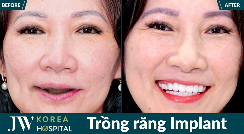 Cô chú U50 - U80 skhooi phục răng mất, ăn ngon, cười đẹp sau Trồng răng Implant tại JW