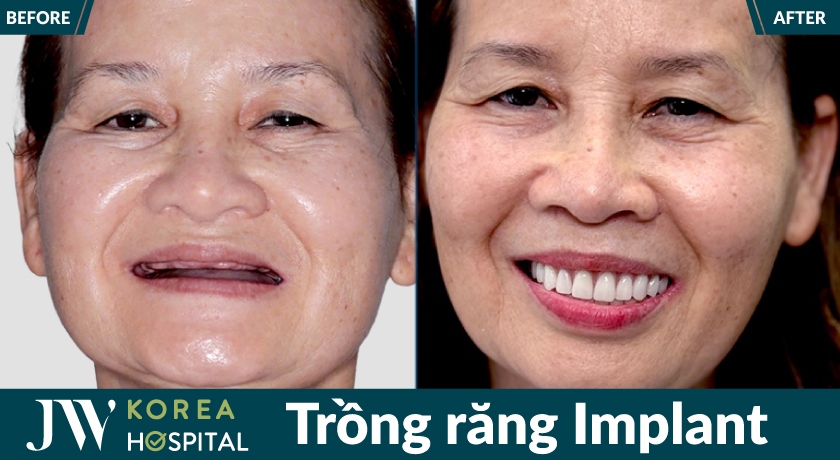 Hình ảnh trước và sau của khách hàng khi trồng răng Implant tại Bệnh viện JW